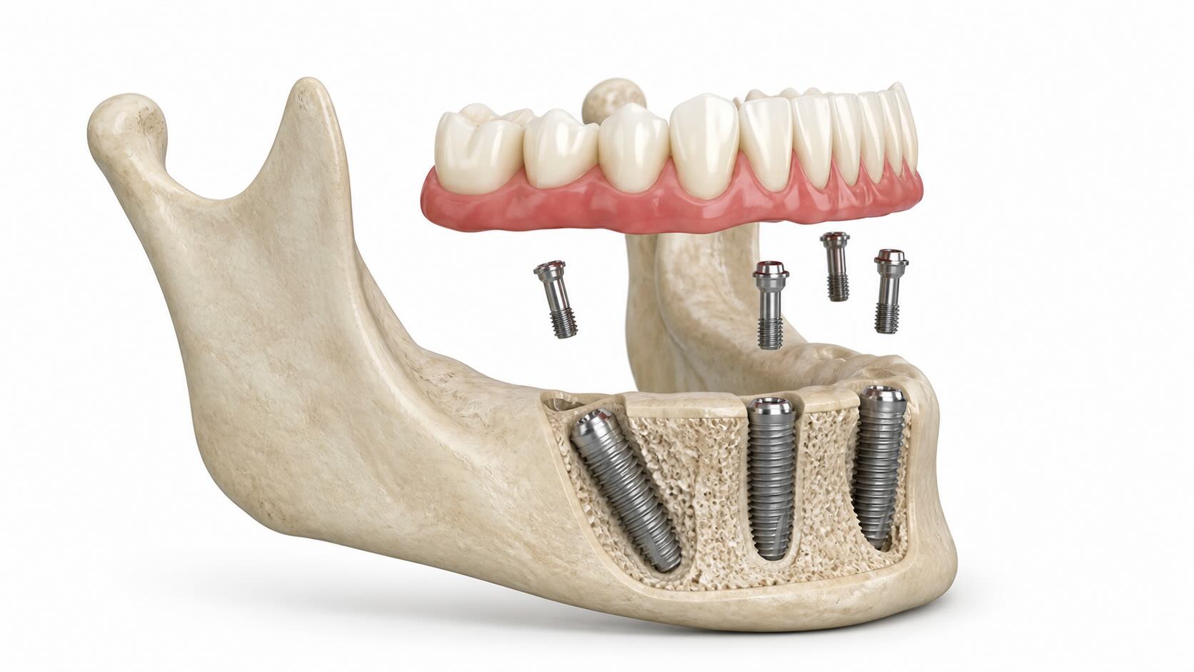 Sistema All-on-4