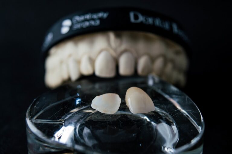 Carillas de Porcelana vs. Resina: Por qué un Diseño de Sonrisa Premium es tu Mejor Inversión en Guayaquil