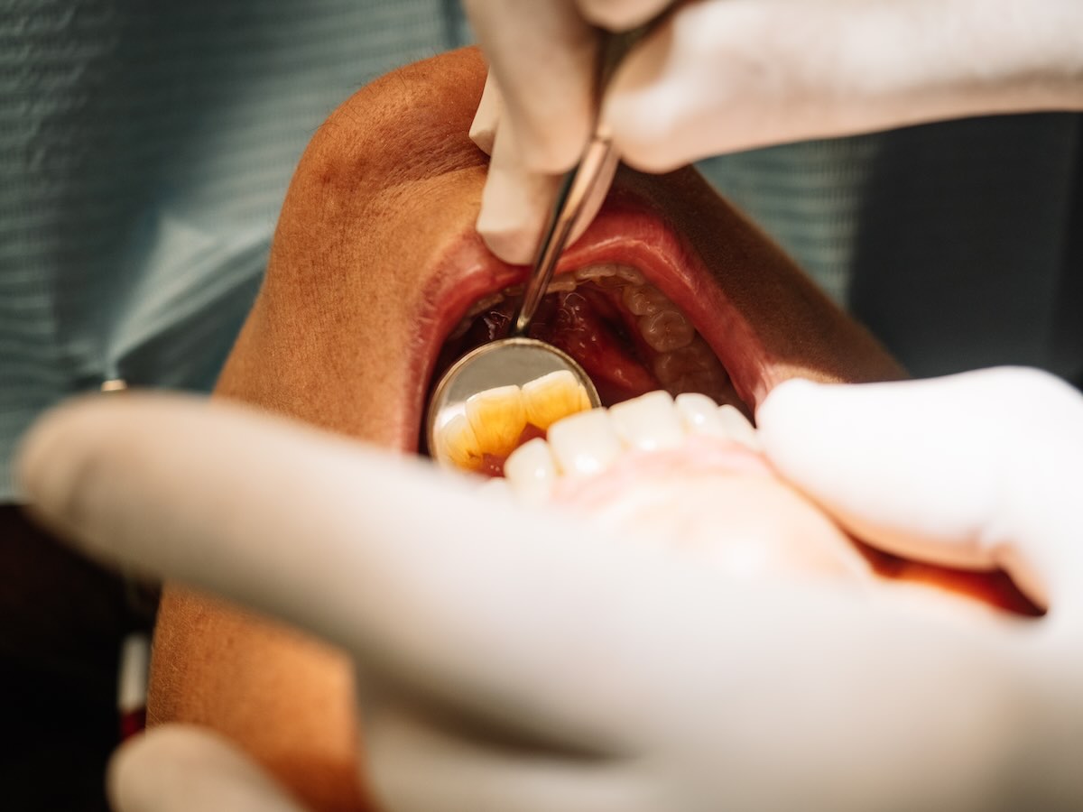 Ferulización dental