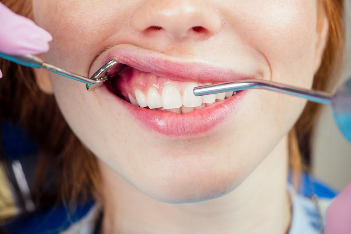 Gingivectomía (Contorneado Estético)