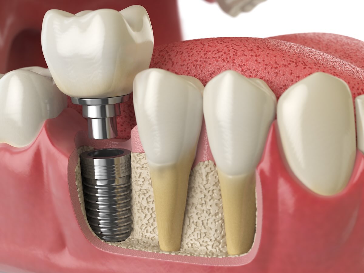 Implantes Individuales
