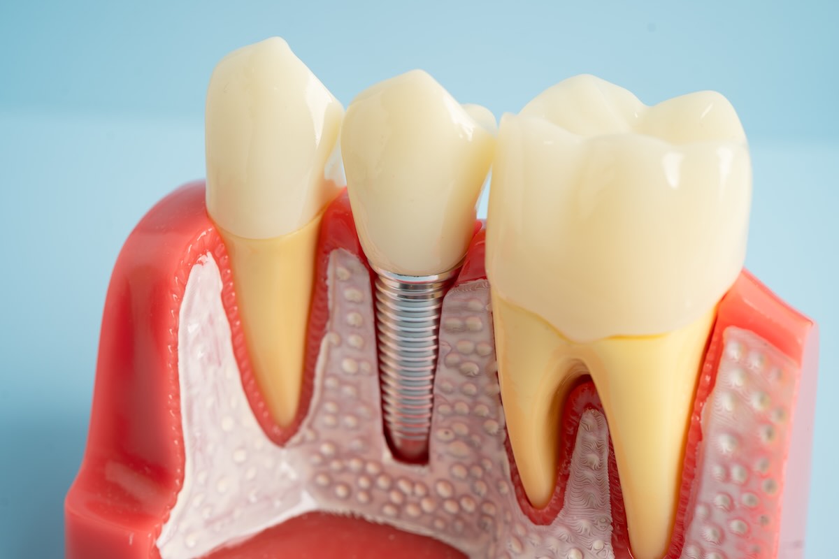 Impantes dentales en guayaquil, Ecuador, en Dental Medical Corp
