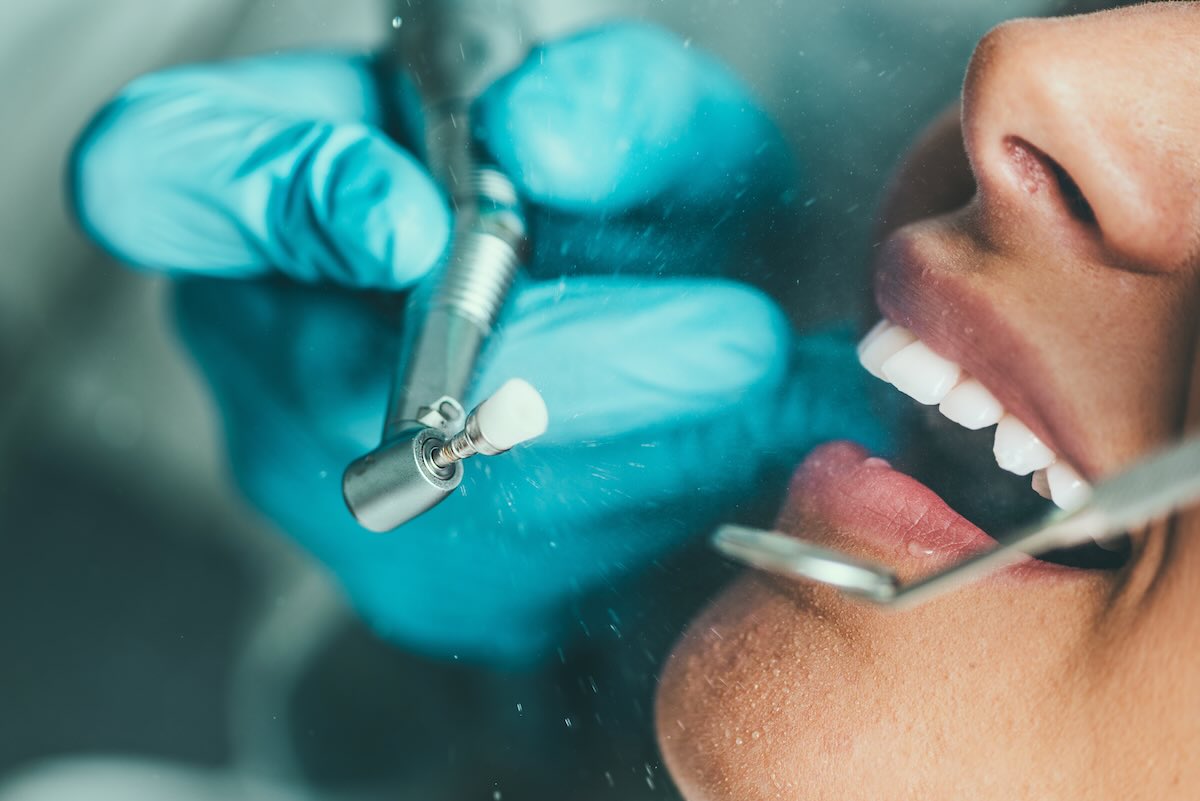 Profilaxis y Limpieza Dental