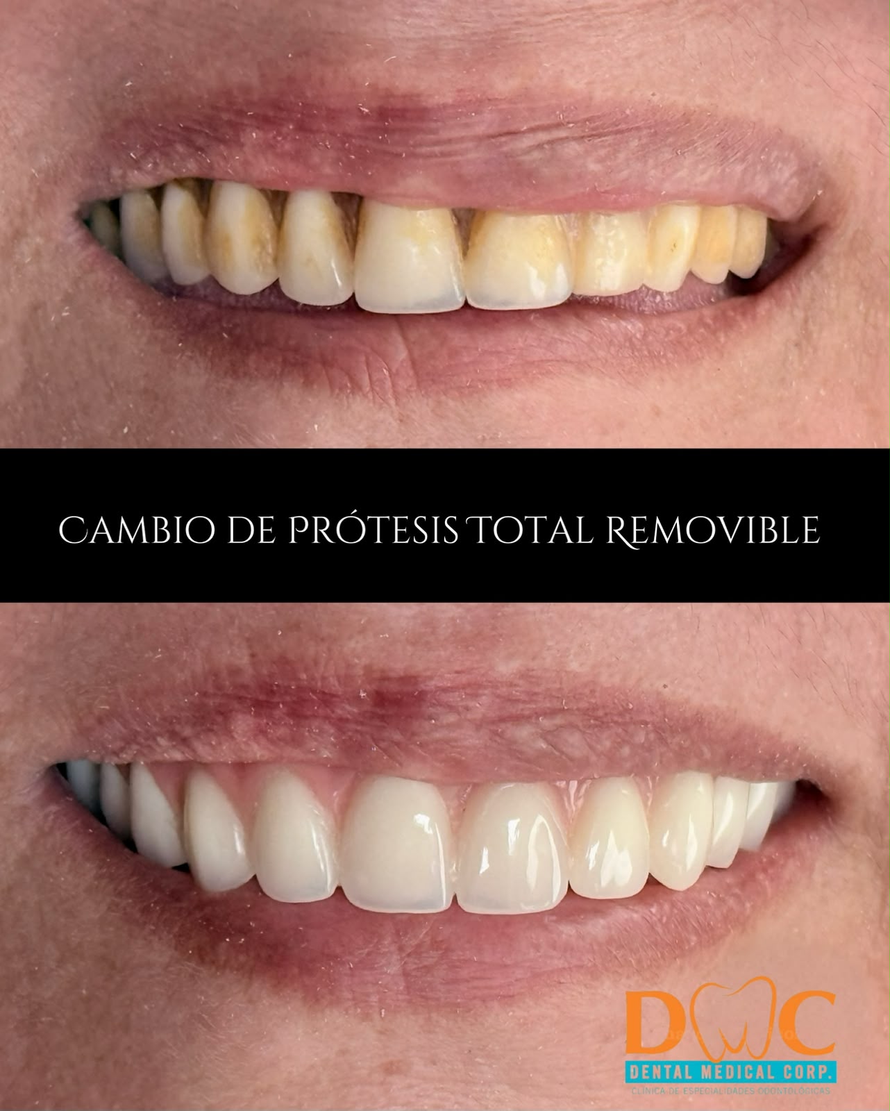 Prótesis removible antes y después