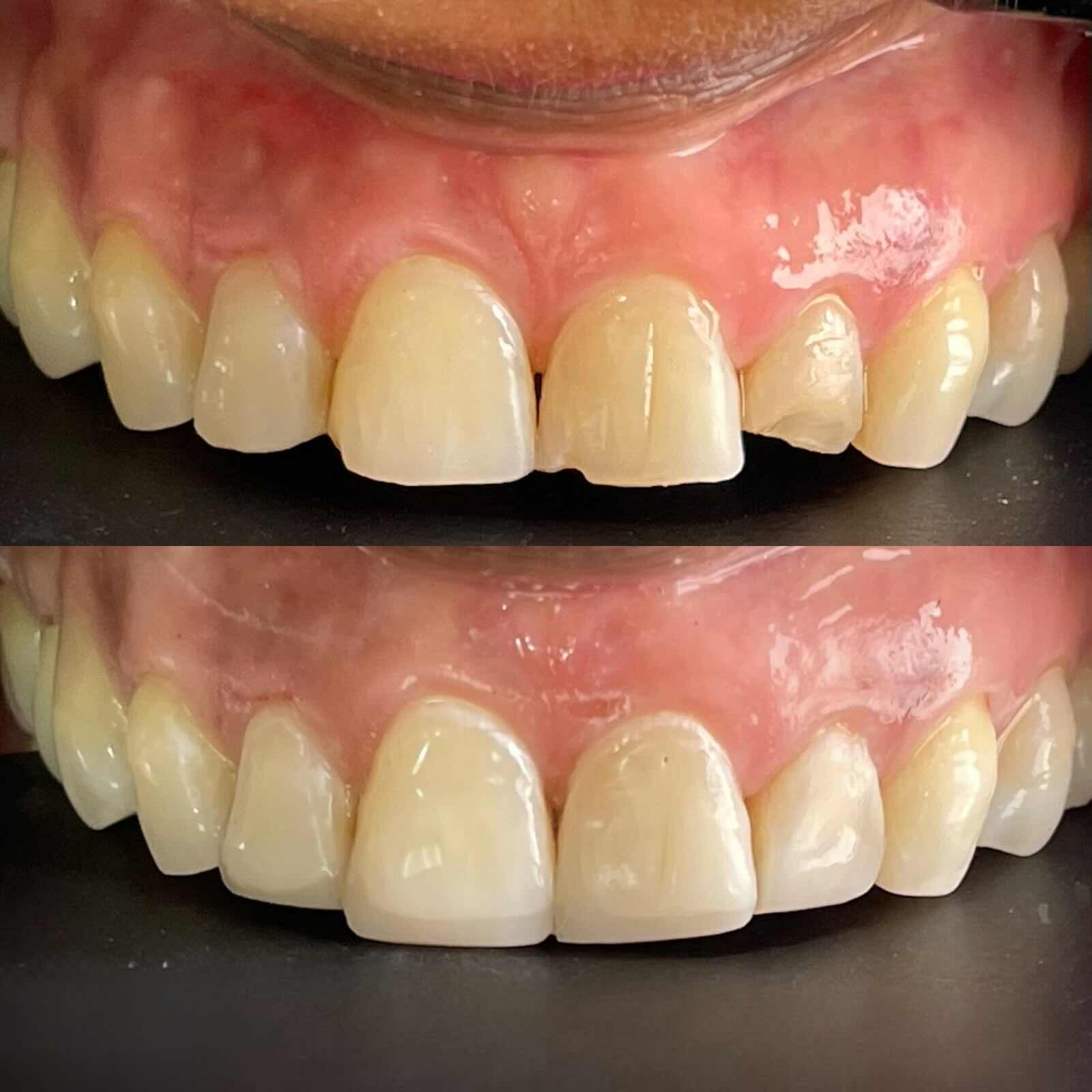 Restauración de fractura de bordes antes y después
